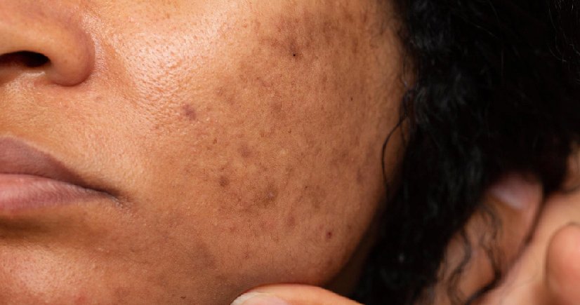 Laser Treatment for pigmentation